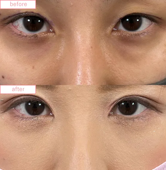 切らないクマ取り症例No.20230507_03