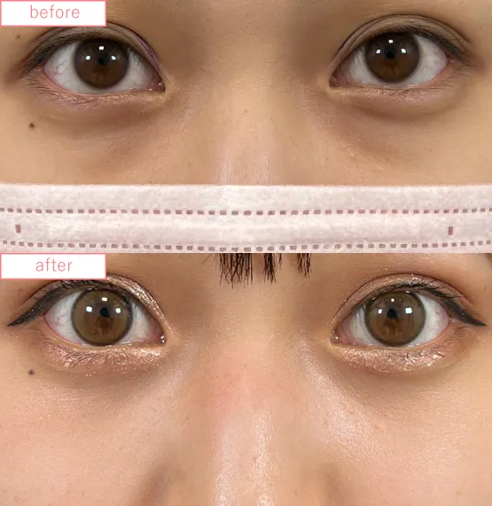 切らないクマ取り症例No.20230507_04