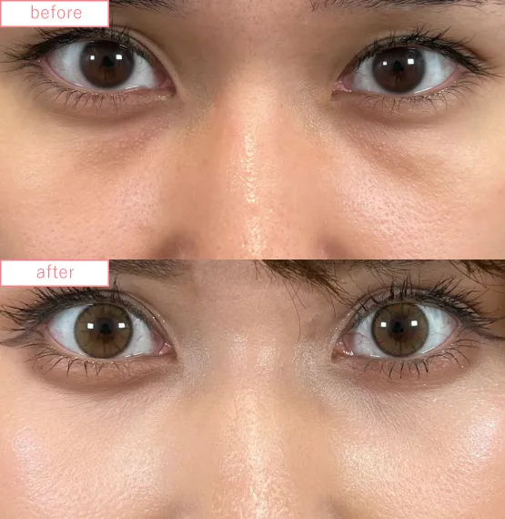 切らないクマ取り症例No.20230507_05