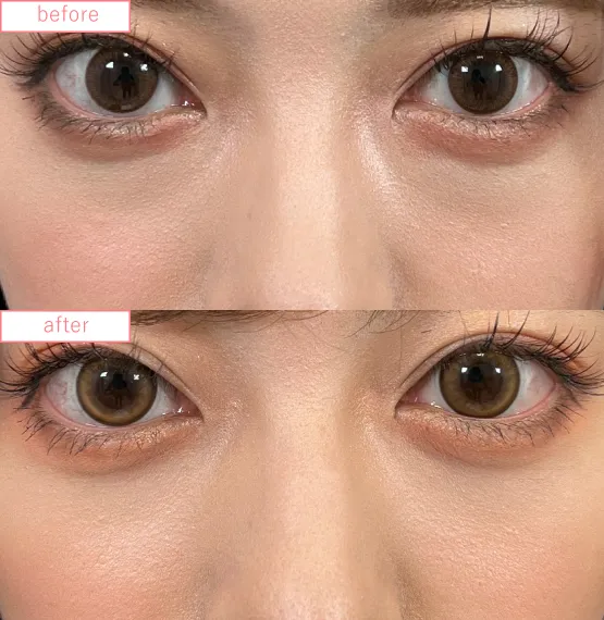 切らないクマ取り症例No.20230507_06