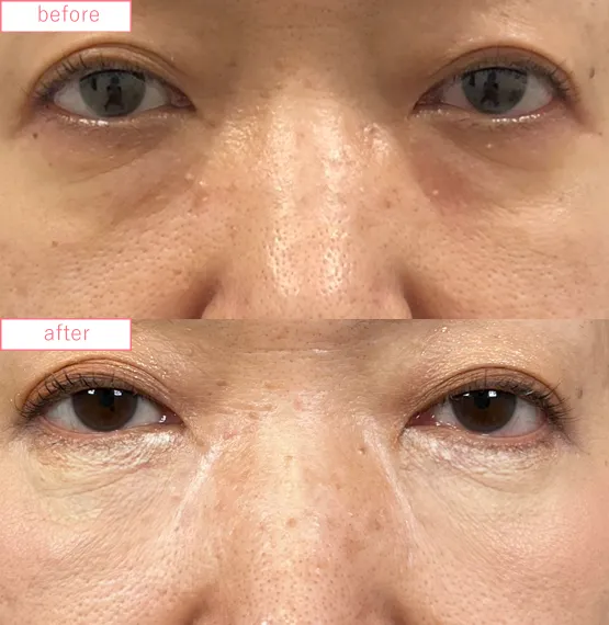 切らないクマ取り症例No.20230507_07