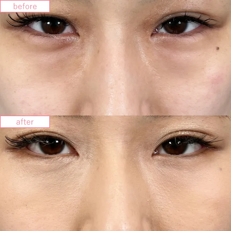 切らないクマ取り症例No.20230507_08