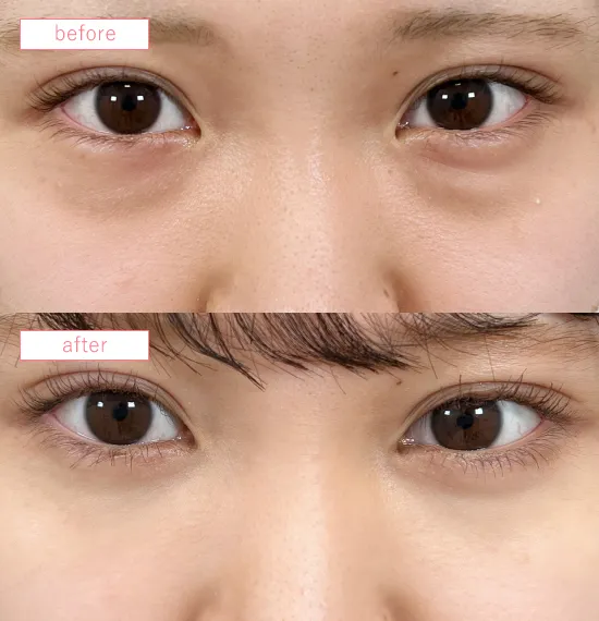 切らないクマ取り症例No.20230507_09