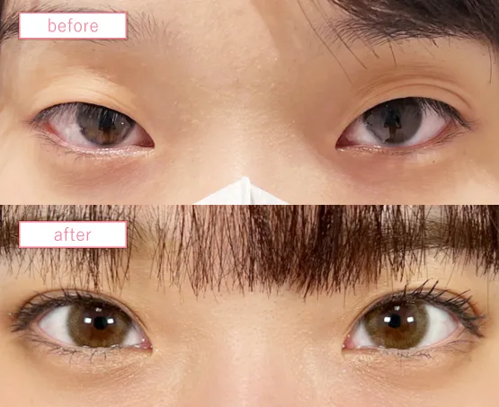 二重埋没法症例No20230519-06