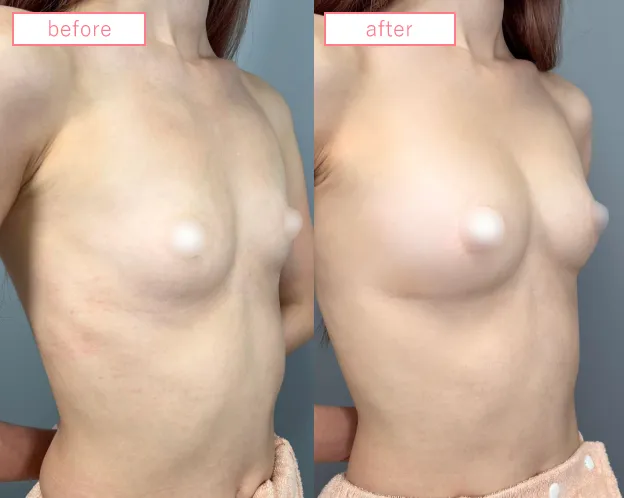 脂肪豊胸症例No20230506-03