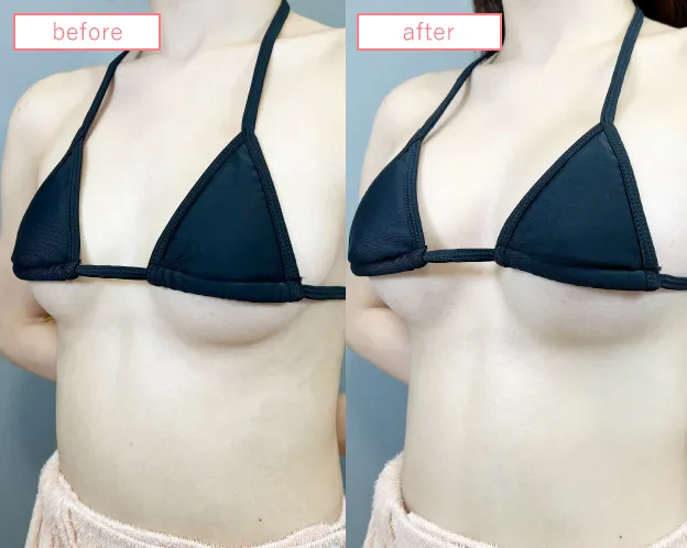 脂肪豊胸症例No20230506-07