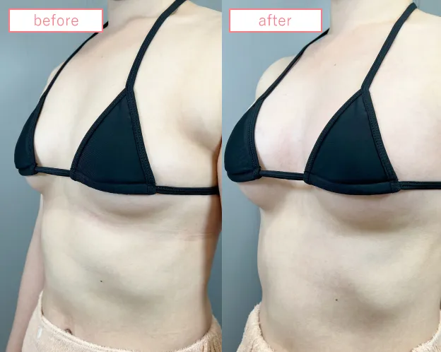 脂肪豊胸症例No20230506-08