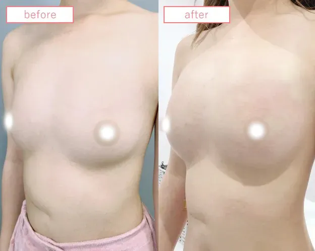 脂肪豊胸症例No20230506-09