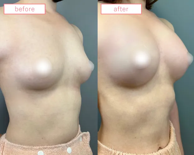 脂肪豊胸症例No20230506-10