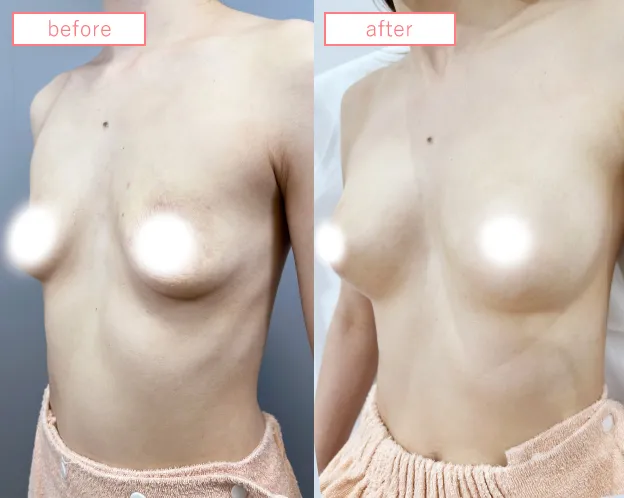脂肪豊胸症例No20230506-13