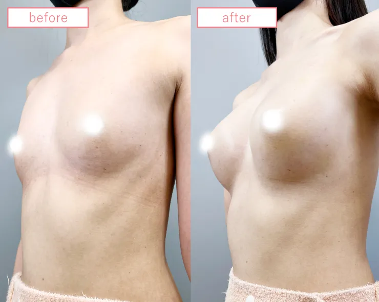 脂肪豊胸症例No20230506-14