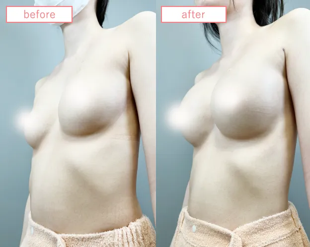 脂肪豊胸No2343