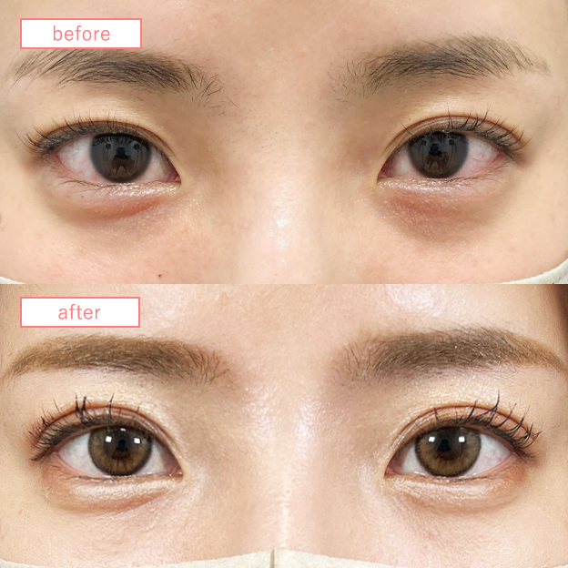 二重埋没法症例No2679