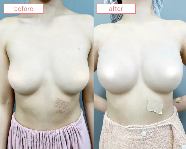 脂肪豊胸症例No2693