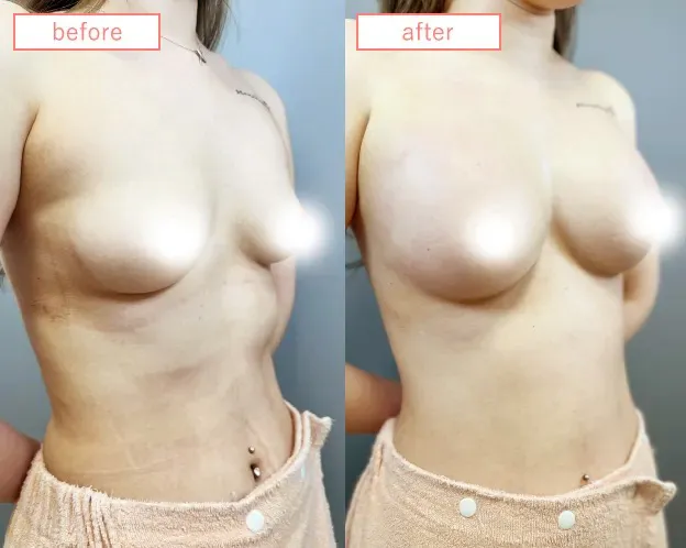 脂肪豊胸症例No2720