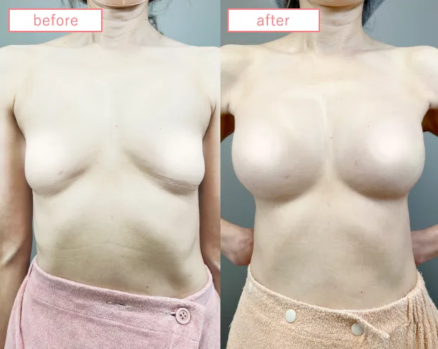 脂肪豊胸症例No466