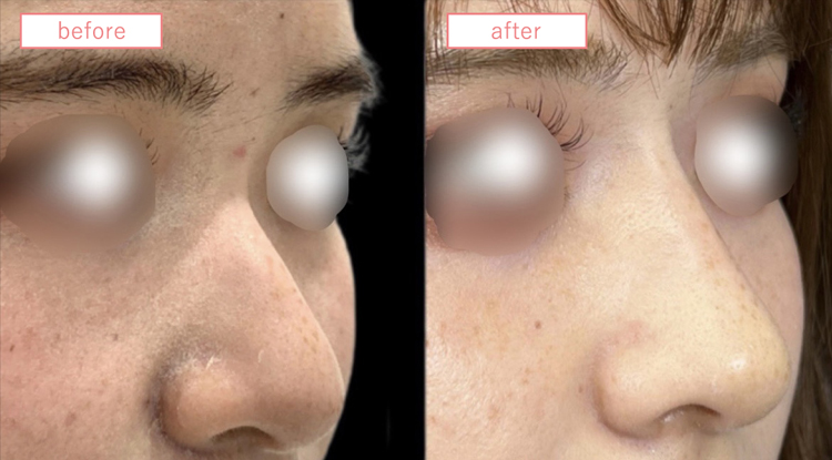 隆鼻術(メッシュ法)症例