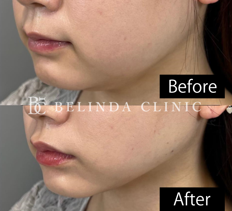 顔脂肪吸引10日後症例