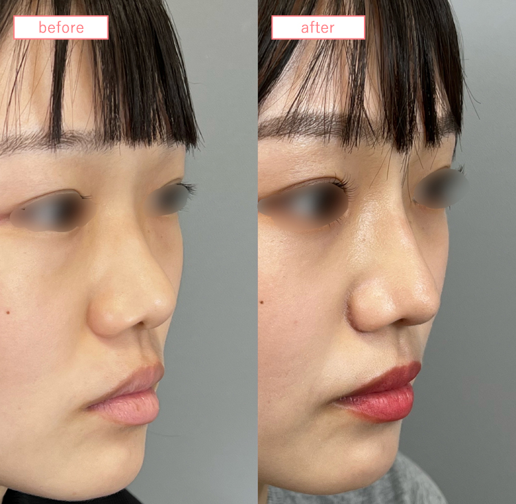 隆鼻術(メッシュ法)症例