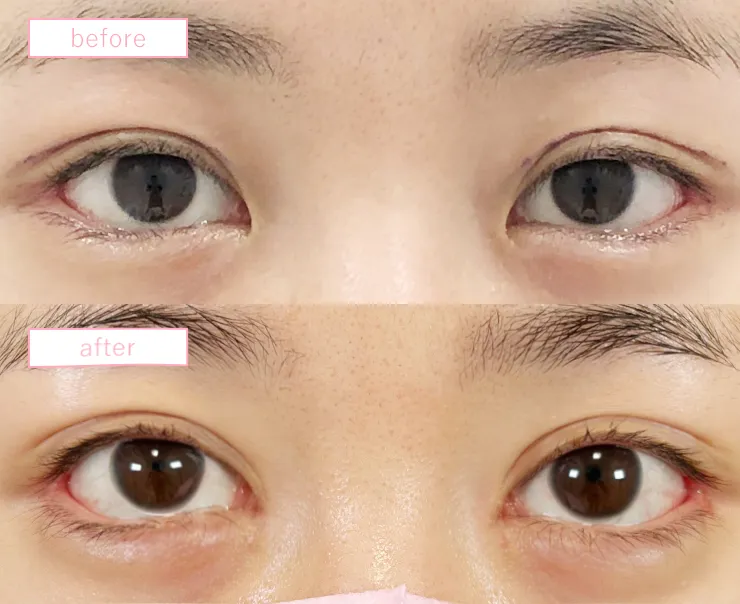 目頭切開症例No20230905