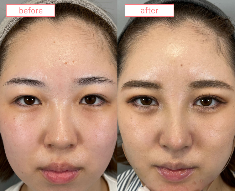 鼻中隔延長ビフォーアフターcase03