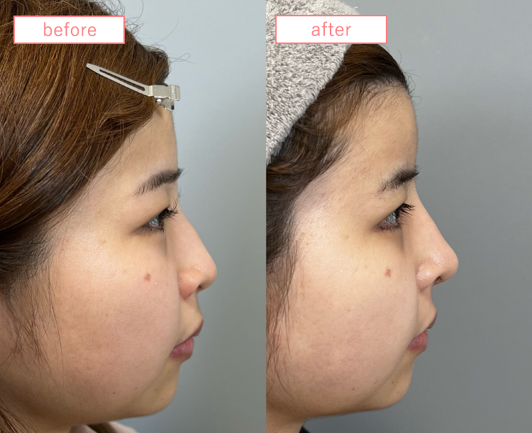 鼻中隔延長・隆鼻術プロテーゼ症例20230915-4