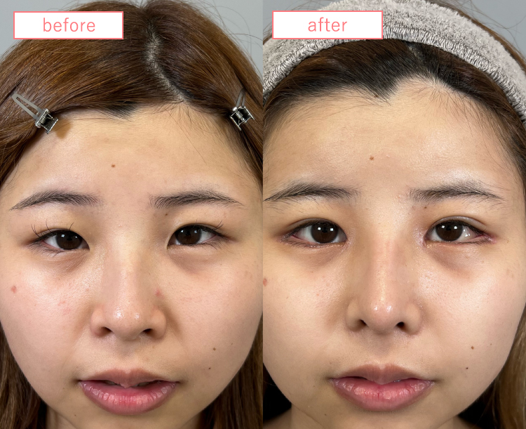 鼻中隔延長ビフォーアフターcase02