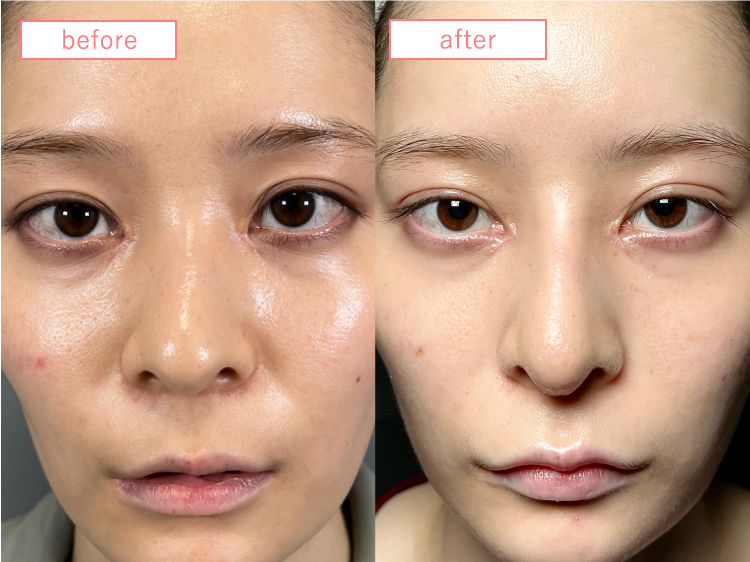 鼻中隔延長・隆鼻術プロテーゼ症例-20230915-2