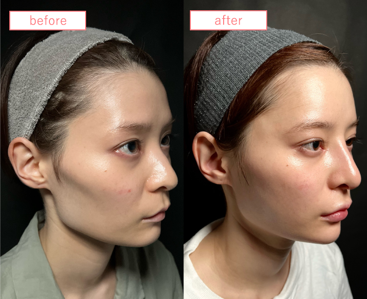 鼻中隔延長ビフォーアフターcase01