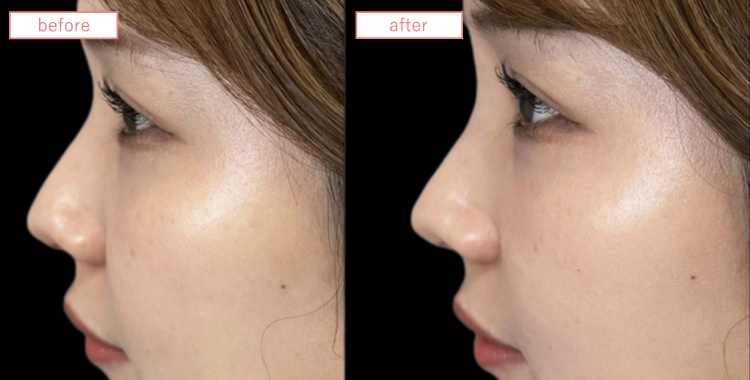 隆鼻術(ヒアルロン酸)症例