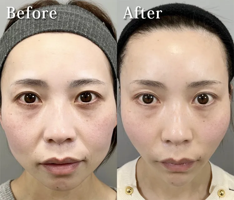 小顔脂肪吸引症例No20231010-01