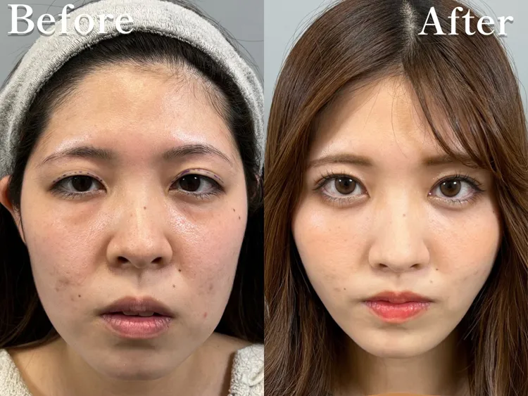 小顔脂肪吸引症例No20231010-03