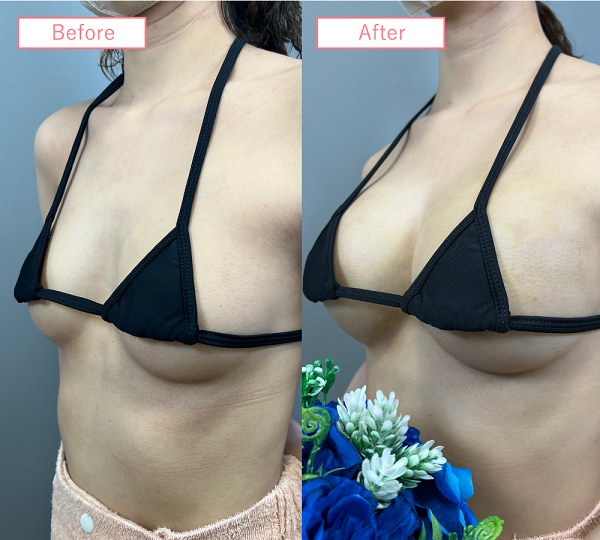 脂肪注入豊胸症例04