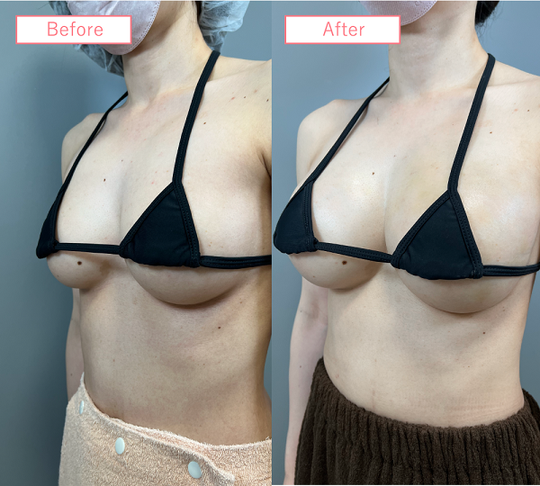 脂肪注入豊胸症例02