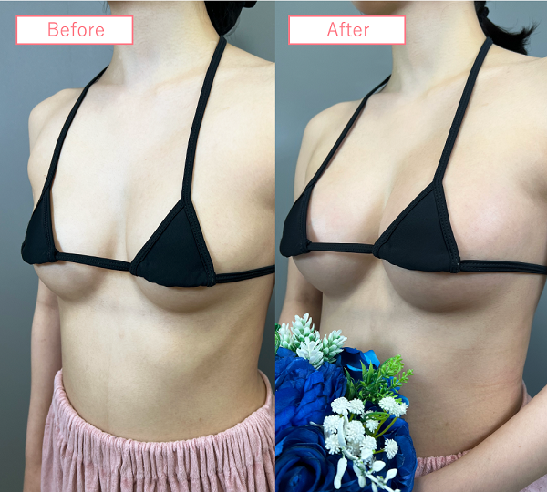 脂肪注入豊胸症例02