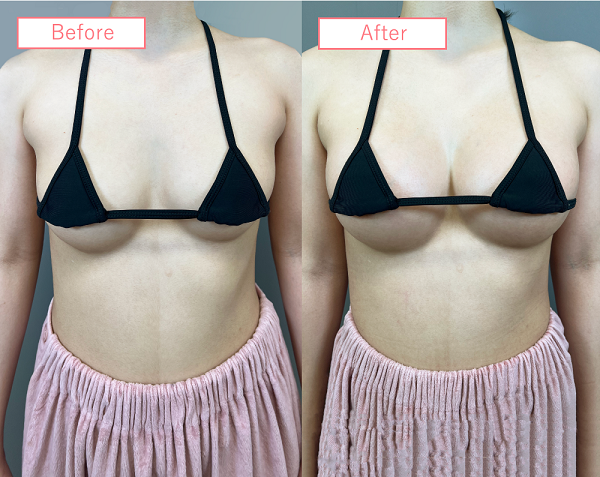 脂肪豊胸No3476_2