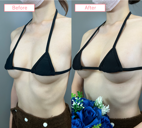 脂肪注入豊胸症例20