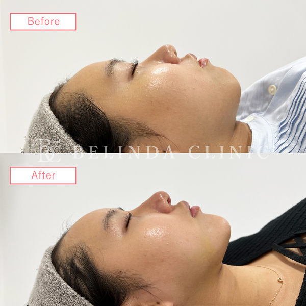 小顔脂肪吸引(顎下・フェイスライン)case08