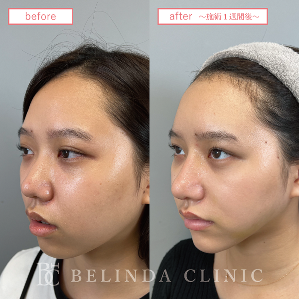 小顔脂肪吸引(頬・フェイスライン)case10