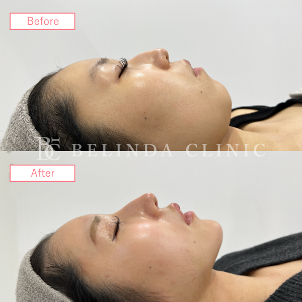 小顔脂肪吸引(顎下・フェイスライン)case07