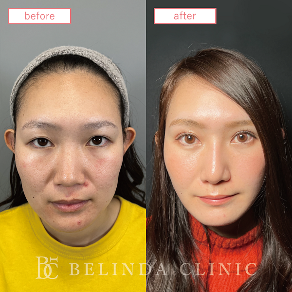 小顔脂肪吸引(フェイスライン)case06