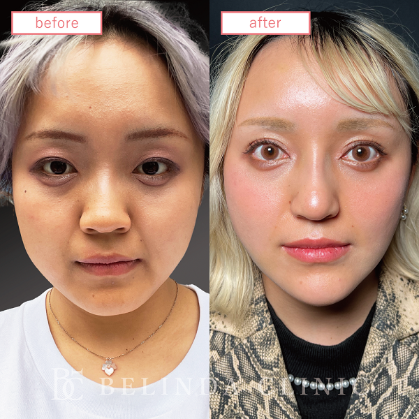 小顔脂肪吸引(頬・フェイスライン)case09