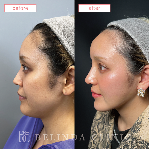 小顔脂肪吸引(顎下・エラ)case11