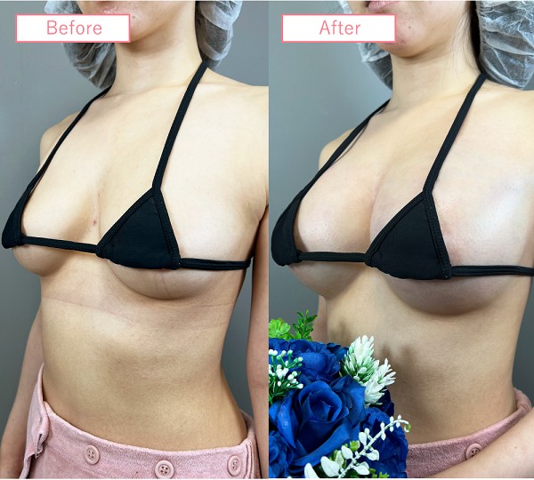 脂肪注入豊胸症例19