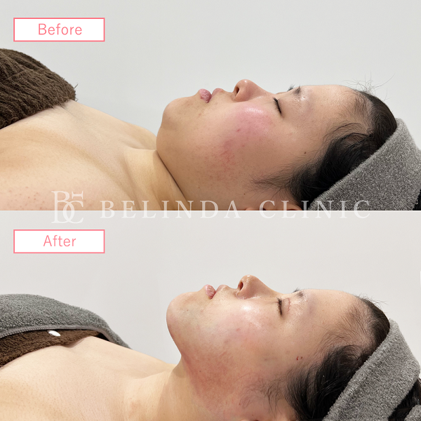 小顔脂肪吸引(顎下・首)case05