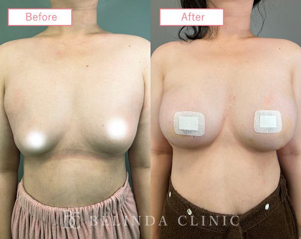 シリコンバッグ豊胸ビフォーアフターcase02