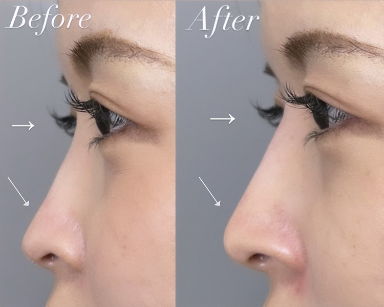 ヒアルロン酸隆鼻術モニタービフォーアフター