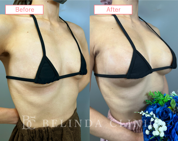 ハイブリット豊胸ビフォーアフターcase02