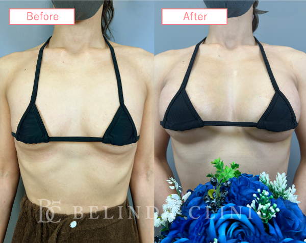 ハイブリット豊胸ビフォーアフターcase01