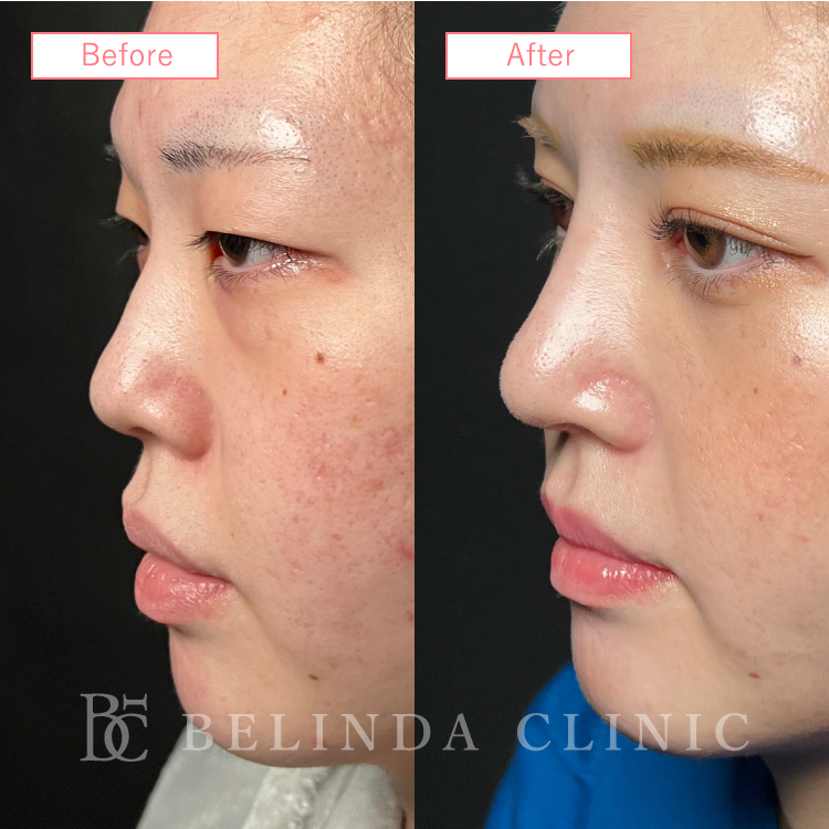 鼻中隔延長ビフォーアフターcase04